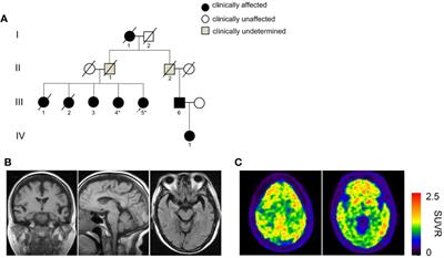 Identification of a Rare PSEN1 Mutation (Thr119Ile) in Late-Onset Alzheimer’s Disease With Early Presentation of Behavioral Disturbance